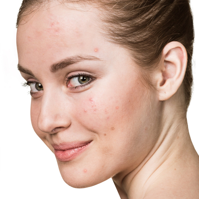 Acne: causes and how to take care of it